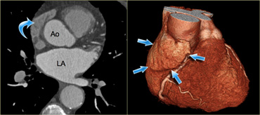 Axial (left) and 3D-reconstructions (right) of the heart demonstrating the right atrial appendage (blue arrows). Ao=aorta, LA=left atrium